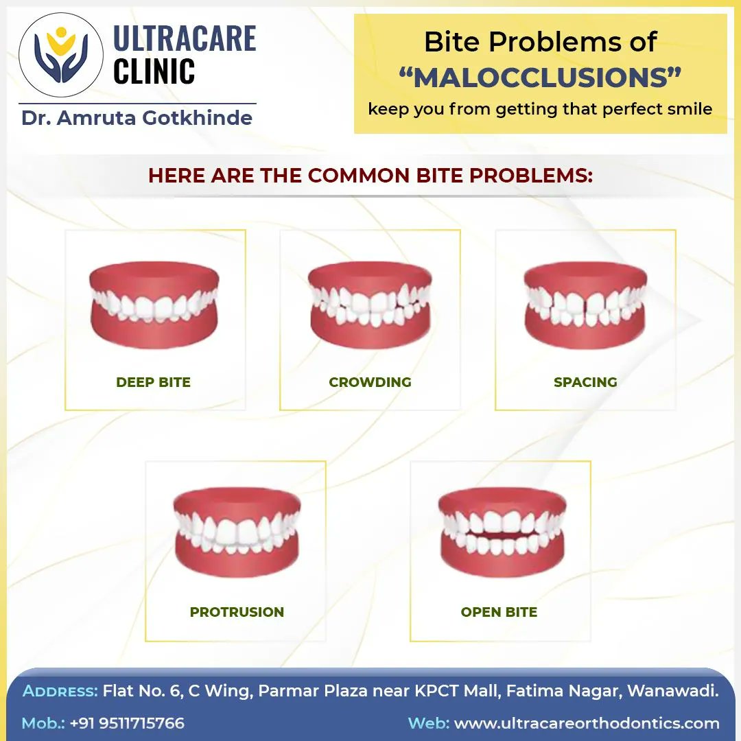 DrAmruta0707's tweet image. Unlocking the Secrets of Common Bite Problems: Discover the challenges and solutions for a healthier smile. 

📞-+919511715766
🌐- buff.ly/3nmX4vS
.
#biteproblems #malocclusion #orthodontics #dramrutagotkhinde #pune