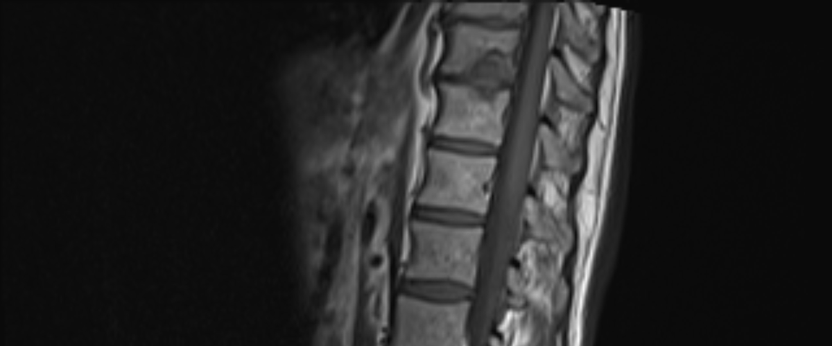 samrad77's tweet photo. Claw sign on DWI (4th image): distinctly defined, paired band-like regions of restricted diffusion that affect two adjacent vertebral bodies and resemble a claw.

Claw: suggest degenerative changes (Modic type 1) rather than spondylodiskitis. 

DWI helps as a problem-solving tool for the spine. 

@amanullahbeg 

@TheASNR @The_ASSR