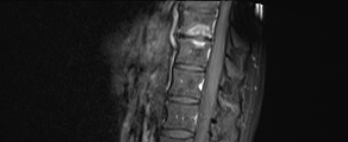samrad77's tweet photo. Claw sign on DWI (4th image): distinctly defined, paired band-like regions of restricted diffusion that affect two adjacent vertebral bodies and resemble a claw.

Claw: suggest degenerative changes (Modic type 1) rather than spondylodiskitis. 

DWI helps as a problem-solving tool for the spine. 

@amanullahbeg 

@TheASNR @The_ASSR