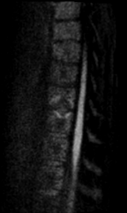 samrad77's tweet photo. Claw sign on DWI (4th image): distinctly defined, paired band-like regions of restricted diffusion that affect two adjacent vertebral bodies and resemble a claw.

Claw: suggest degenerative changes (Modic type 1) rather than spondylodiskitis. 

DWI helps as a problem-solving tool for the spine. 

@amanullahbeg 

@TheASNR @The_ASSR