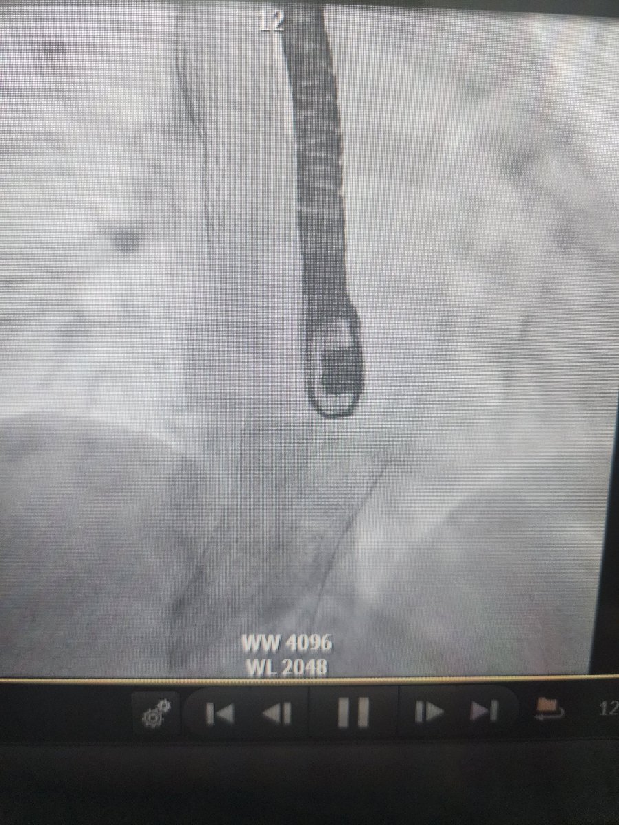 assiri99's tweet photo. 68 obese lady with DM, DLP &amp; Isolated symptomatic Torrential TR
Turned down for surgery 
Not suitable for Clip given valve is not coapting
Considerred for #TricValve 

Thanks @KFAFHCards team 

@mirvatalasnag @fayezbaraah @wagarhabib @drptca @ibrahem_albakry @mohamed_elsabah https://t.co/nQtO5pt1r4