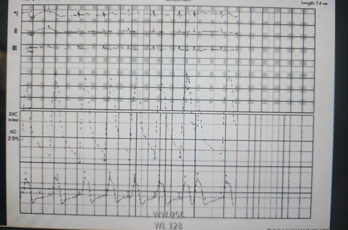assiri99's tweet photo. 68 obese lady with DM, DLP &amp; Isolated symptomatic Torrential TR
Turned down for surgery 
Not suitable for Clip given valve is not coapting
Considerred for #TricValve 

Thanks @KFAFHCards team 

@mirvatalasnag @fayezbaraah @wagarhabib @drptca @ibrahem_albakry @mohamed_elsabah https://t.co/nQtO5pt1r4