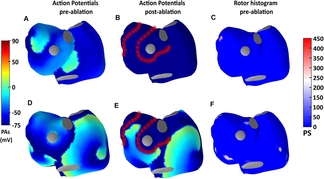 PersonalizeAF (@personalizeaf) on Twitter photo Pulmonary vein isolation is a successful treatment for Atrial Fibrillation (AF). In this study, <a href="/CarlosFambuena/">@CarlosFambuena</a>, ESR11 at @upv, evaluated using #ECGI to identify reentries and #rotor density in the PV area to indicate PVI outcome. #PersonalizeAF #AtrialFibrillation #Research Pulmonary vein isolation is a successful treatment for Atrial Fibrillation (AF). In this study, <a href="/CarlosFambuena/">@CarlosFambuena</a>, ESR11 at @upv, evaluated using #ECGI to identify reentries and #rotor density in the PV area to indicate PVI outcome. #PersonalizeAF #AtrialFibrillation #Research