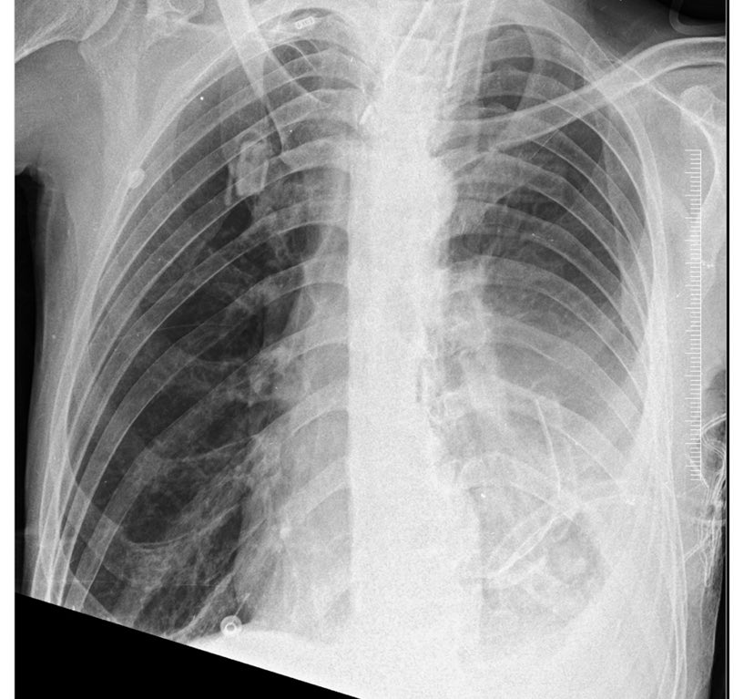 Learning for today: If it is empyema, break the septae/loculations and insert the chest drain. 
#CriticalCare