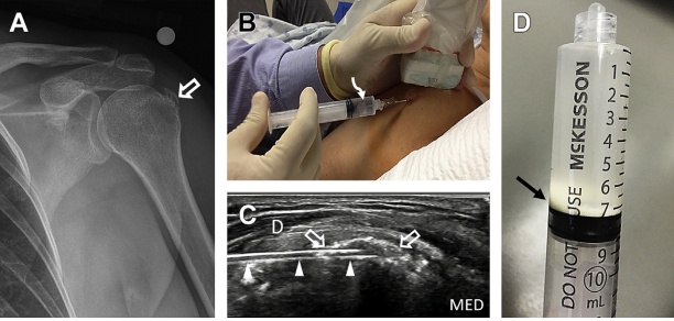 Ultrasound-Guided Interventional Procedures About the Shoulder Anatomy, Indications, and Techniques FREE PDF mskultrasound.co.nz/wp-content/upl…