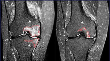 That’s impressive 

Embolization reduces bone edema in knee #osteoarthritis ! 

« This pilot study suggested that GAE effectively reduces BML area and volume and improves pain and physical function in patients with knee OA accompanied by BML » <a href="/JVIRmedia/">JVIR</a> 

jvir.org/article/S1051-…