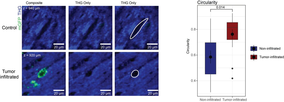 12/Interestingly, our research has defined an imaging biomarker of white matter disruption during early glioblastoma colonization marking an interesting starting point for clinical imaging biomarker development.