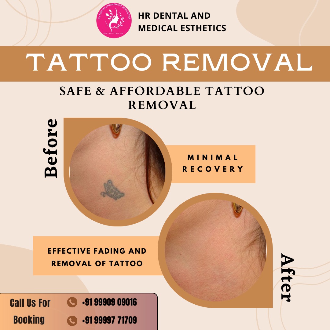 HR Dental and Medical Aesthetics is here to guide you through a personalized tattoo removal experience, tailored to your unique needs.
For bookings, call Dr. Himani Bhardwaj at +91 99997 71709 or visit our clinic at SB 34, Shashtri Nagar, Ghaziabad. 
 #TattooRemoval #LaserRemoval