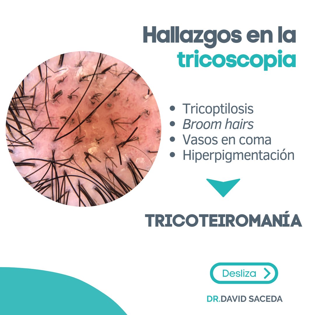 Desaze's tweet photo. Algo indispensable en la consulta de tricología de un dermatólogo es la tricoscopia.🔍 Es una técnica rápida, que no implica molestias y nos aporta muchísima información valiosa sobre el estado del cabello. https://t.co/NfPnFWYQP0