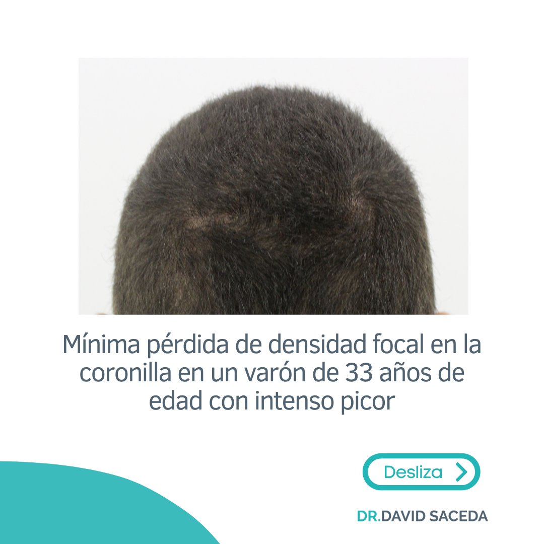 Desaze's tweet photo. Algo indispensable en la consulta de tricología de un dermatólogo es la tricoscopia.🔍 Es una técnica rápida, que no implica molestias y nos aporta muchísima información valiosa sobre el estado del cabello. https://t.co/NfPnFWYQP0