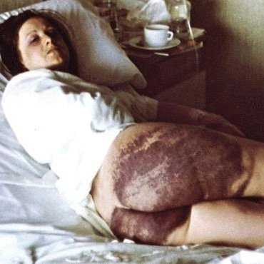 Amparo Arangoa, torturada por la Guardia Civil en 1976. Esta foto dio la vuelta al mundo y destapó el horror de esta herramienta de violencia institucional. Y no se puede analizar sin perspectiva de género. Sigo... (hilo duro)
Día Internacional de Apoyo a Víctimas de la Tortura.