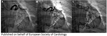 ESC_Journals's tweet image. Anomalous origin of the LCX from the PA associated with non-compaction of the left ventricle: usefulness of #MultimodalityImaging bit.ly/46lp376

#EHJCaseReports @KardiologieHH @aayshacader  @ANazmiCalik @TJ_Yeo  @Phiso_de  @EHJCREiC @FarhanaAra