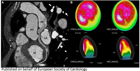 ESC_Journals's tweet image. Anomalous origin of the LCX from the PA associated with non-compaction of the left ventricle: usefulness of #MultimodalityImaging bit.ly/46lp376

#EHJCaseReports @KardiologieHH @aayshacader  @ANazmiCalik @TJ_Yeo  @Phiso_de  @EHJCREiC @FarhanaAra