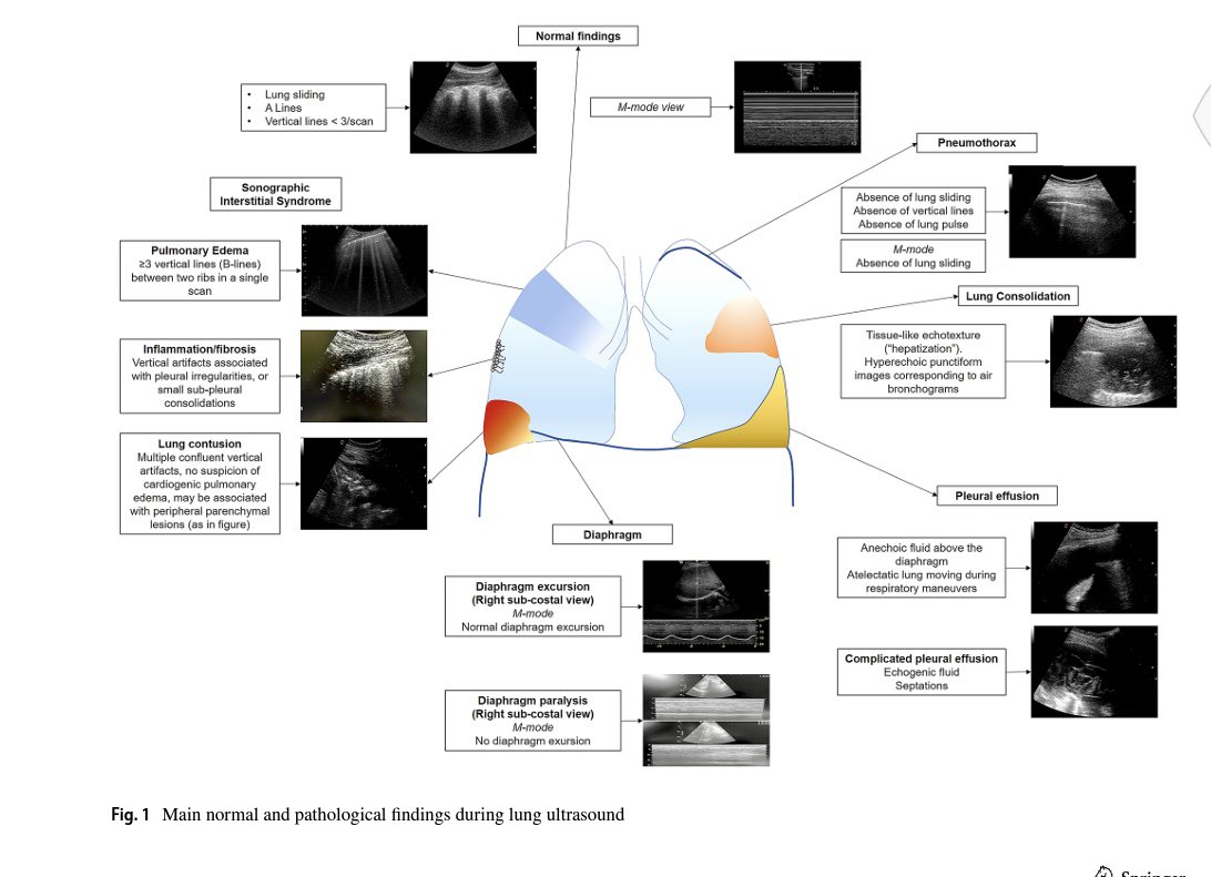 ARUMED1's tweet image. Manejo de la Disnea 🫁🫁🫁

✅ Ecografía pulmonar y ECOTT, son precisos como estándar de atención en la evaluación de varias afecciones que cursan con disnea aguda: 
🔅 neumonía
🔅derrame pleural y pericárdico
🔅neumotórax 
🔆insuficiencia cardíaca

link.springer.com/content/pdf/10…