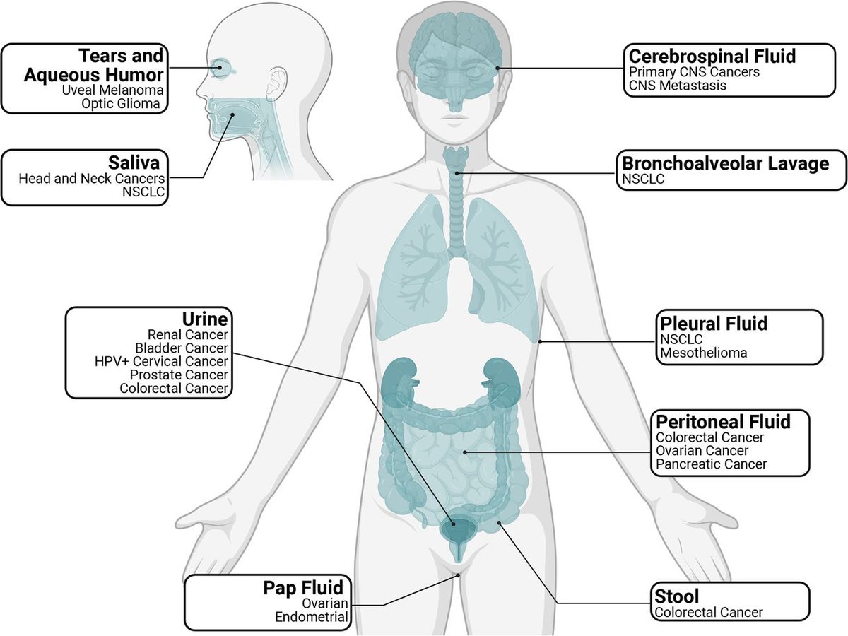 Journal for ImmunoTherapy of Cancer (@jitcancer) on Twitter photo New #JITC review: Genomic approaches to cancer and minimal residual disease detection using circulating tumor DNA jitc.bmj.com/content/11/6/e… <a href="/semenko/">Nick Semenkovich, MD PhD</a> <a href="/EarlandNoah/">Noah Earland</a> <a href="/BrunaPellini/">Bruna Pellini, MD</a> <a href="/aadel_chaudhuri/">Aadel Chaudhuri, MD PhD</a> New #JITC review: Genomic approaches to cancer and minimal residual disease detection using circulating tumor DNA jitc.bmj.com/content/11/6/e… <a href="/semenko/">Nick Semenkovich, MD PhD</a> <a href="/EarlandNoah/">Noah Earland</a> <a href="/BrunaPellini/">Bruna Pellini, MD</a> <a href="/aadel_chaudhuri/">Aadel Chaudhuri, MD PhD</a>