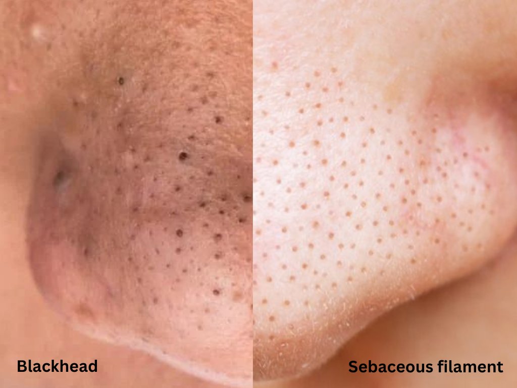 claudia christin on Twitter "Why your blackheads are not going away