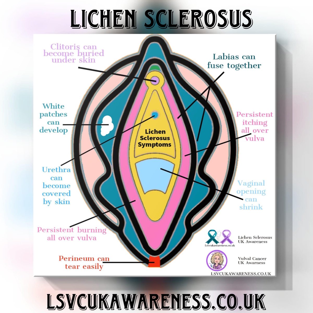 VulvalCancerUK's tweet photo. Research into #LichenSclerosus and dvin
As well as awareness is needed so please help sign this petition. We only have 6 weeks to reach 10k signatures 

https://t.co/PvyztR04OQ https://t.co/tNmcgRibDF