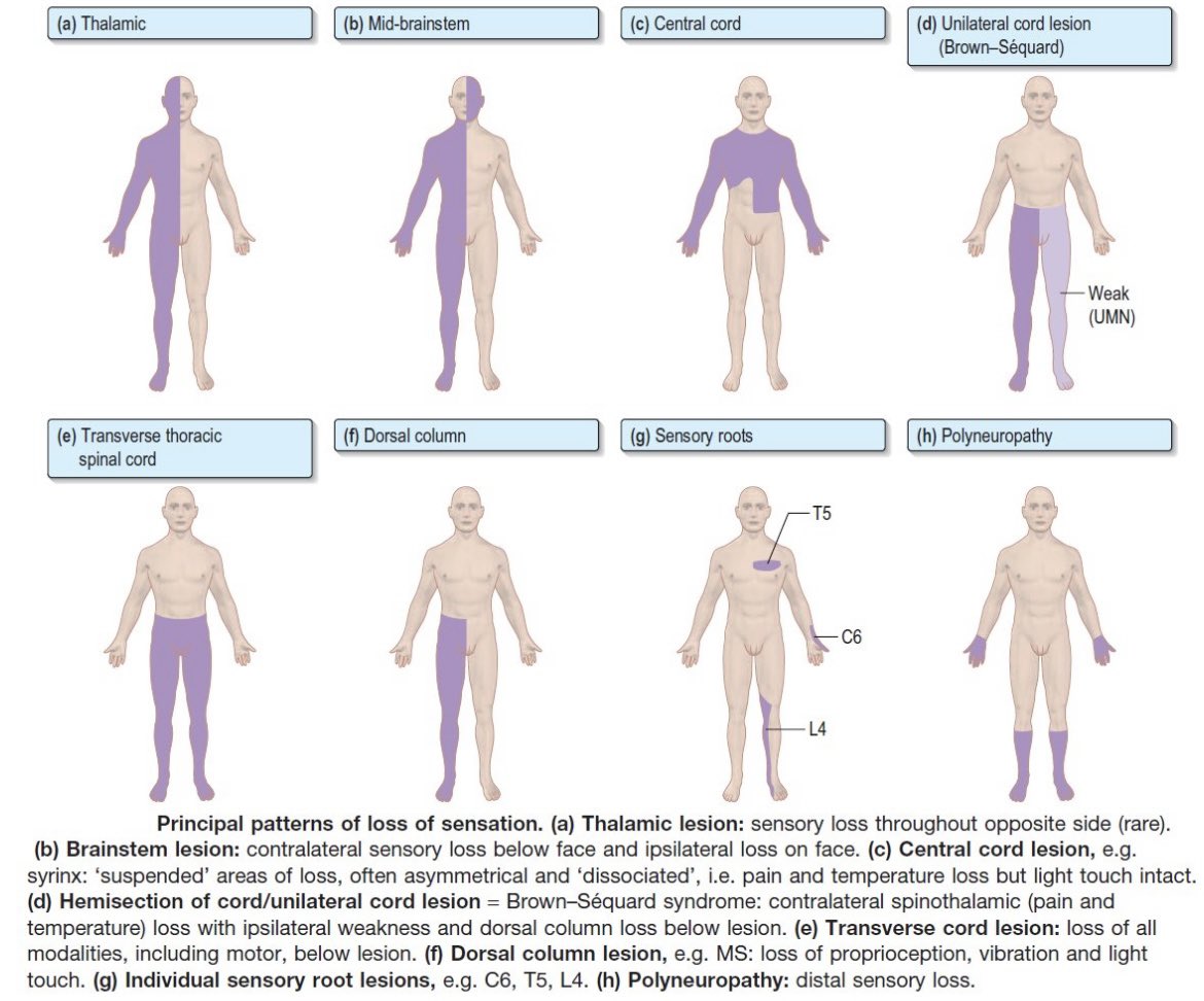 Principal patterns of loss of sensation. #FOAMed #MedEd #MedTwitter #Emergency #FOAped #residents #Students #medicaleducation #medicalstudent #medicalpractice #Neurology #neuroscience #neurotwitter #Emergency #emergencymedicine #icu #Nicu #CriticalCare