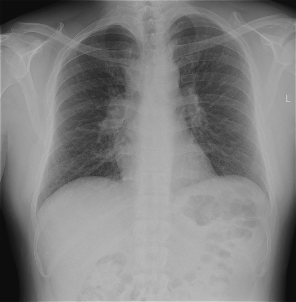 A 35 yo man p/w spinal pain for 3 months,worse in the thoracic spine.Pain worsens with rest& improves with activity.Labs-⬆️ ESR. No recent hx of trauma. What is the radiologic sign seen here? Guess the diagnosis.
#MedTwitter #medicine #MedEd #Health #radiology #Clinical