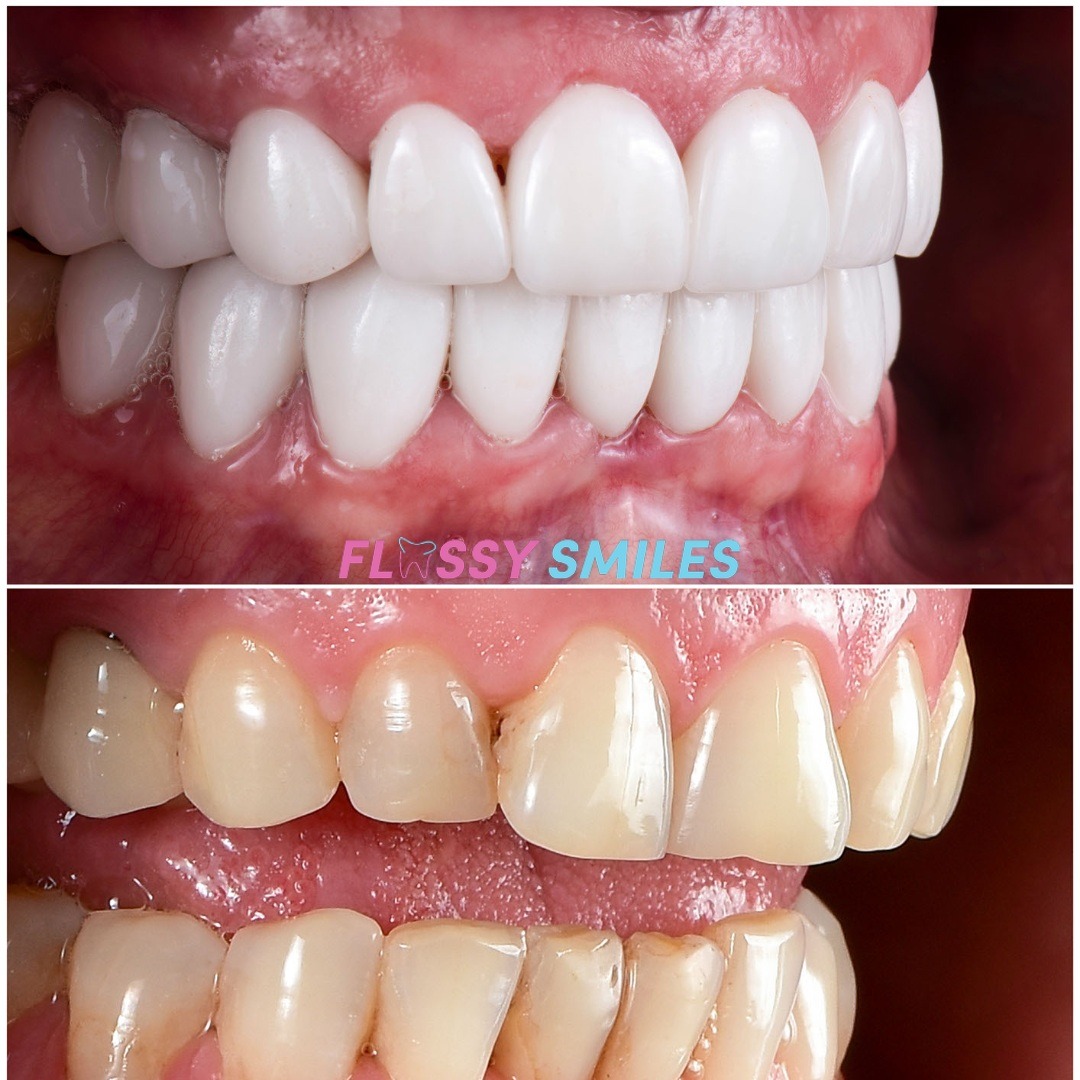 No prep #CompositeVeneers. Alternative to porcelain at a fraction of the cost!

#veneers #dentalveneers #carillas