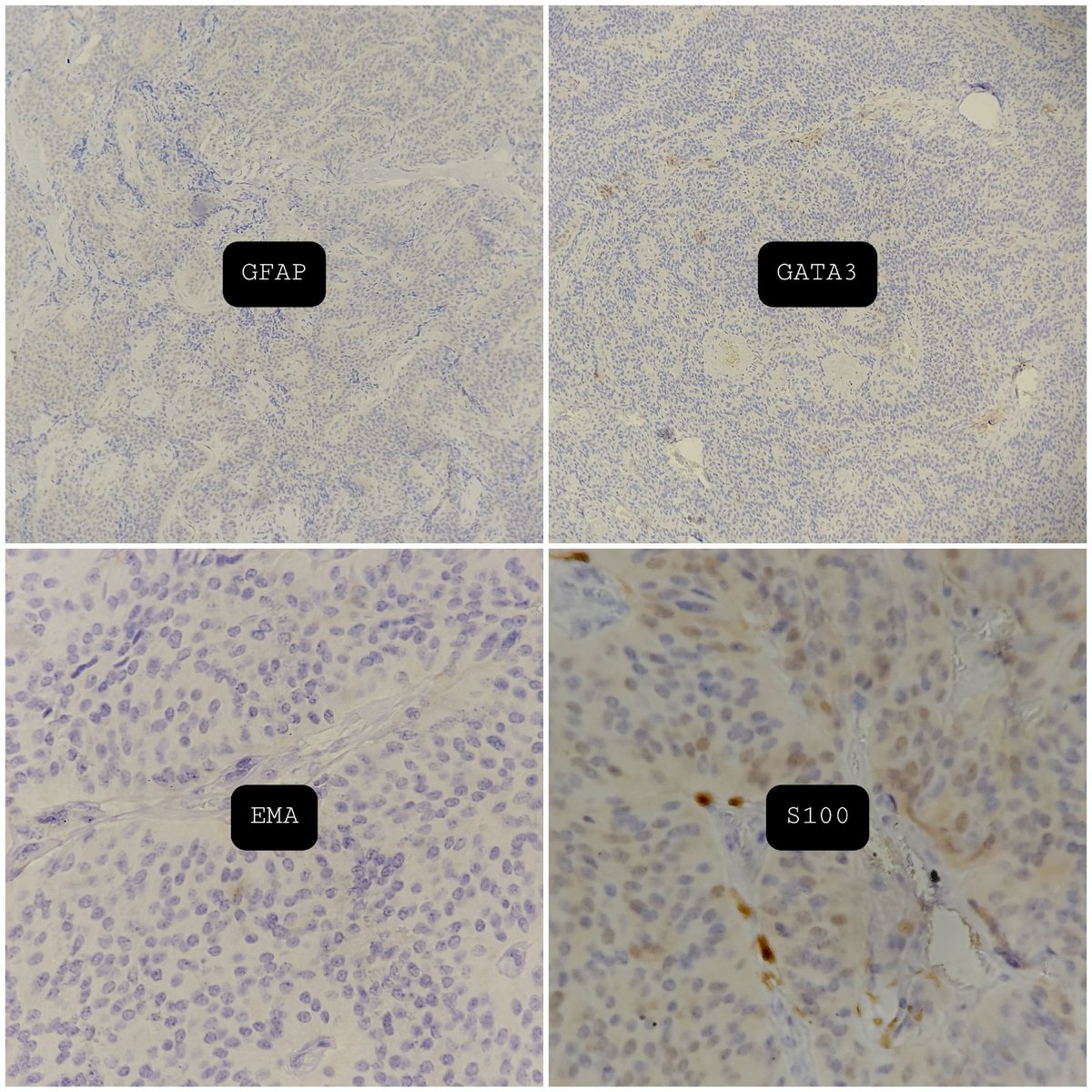 #PathTwitter #neuropath Spinal mass in middle aged ♂️
#pathresidents 
Diagnosis?