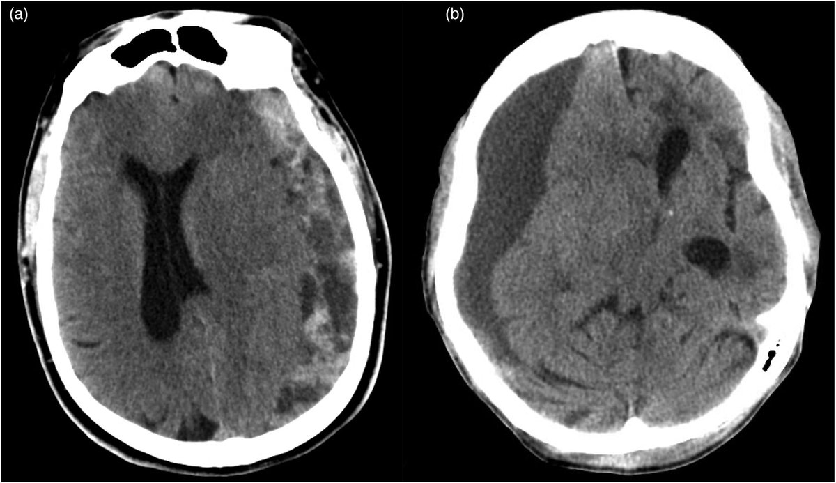 cSDH with membranes/septations. Have you ever said/heard these benefit the most from MMAE? Well now we have the data. Consider sharing tinyurl.com/ysfvxanf @INR_WFITN @UTHealthHouston @SDAmato_MD @s_hyunwookim @MichaelNahhas @RocChenMD @SunilAShethMD