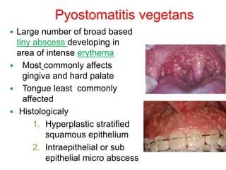 <a href="/BrownJHM/">Journal of Brown Hospital Medicine</a> Pyostomatitis vegetans