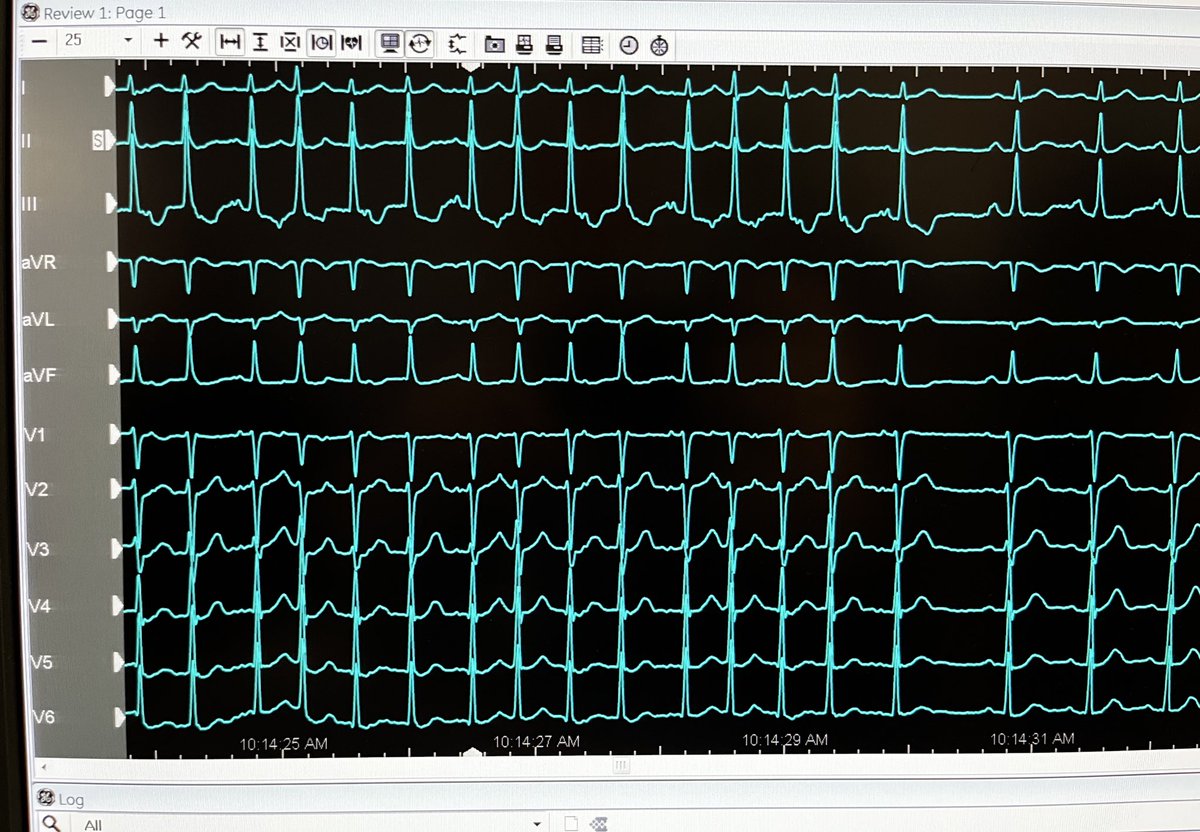 LeshemEran's tweet photo. 30F with recurrent AT. 
Started in sinus rhythm, however catheter motion in the RA caused a stable focal AT. 
Ablation at the foci abolished the AT with no need to cross to the LA. 
#EPeeps https://t.co/Rl7bpI6YGz