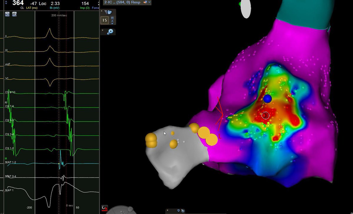 LeshemEran's tweet photo. 30F with recurrent AT. 
Started in sinus rhythm, however catheter motion in the RA caused a stable focal AT. 
Ablation at the foci abolished the AT with no need to cross to the LA. 
#EPeeps https://t.co/Rl7bpI6YGz