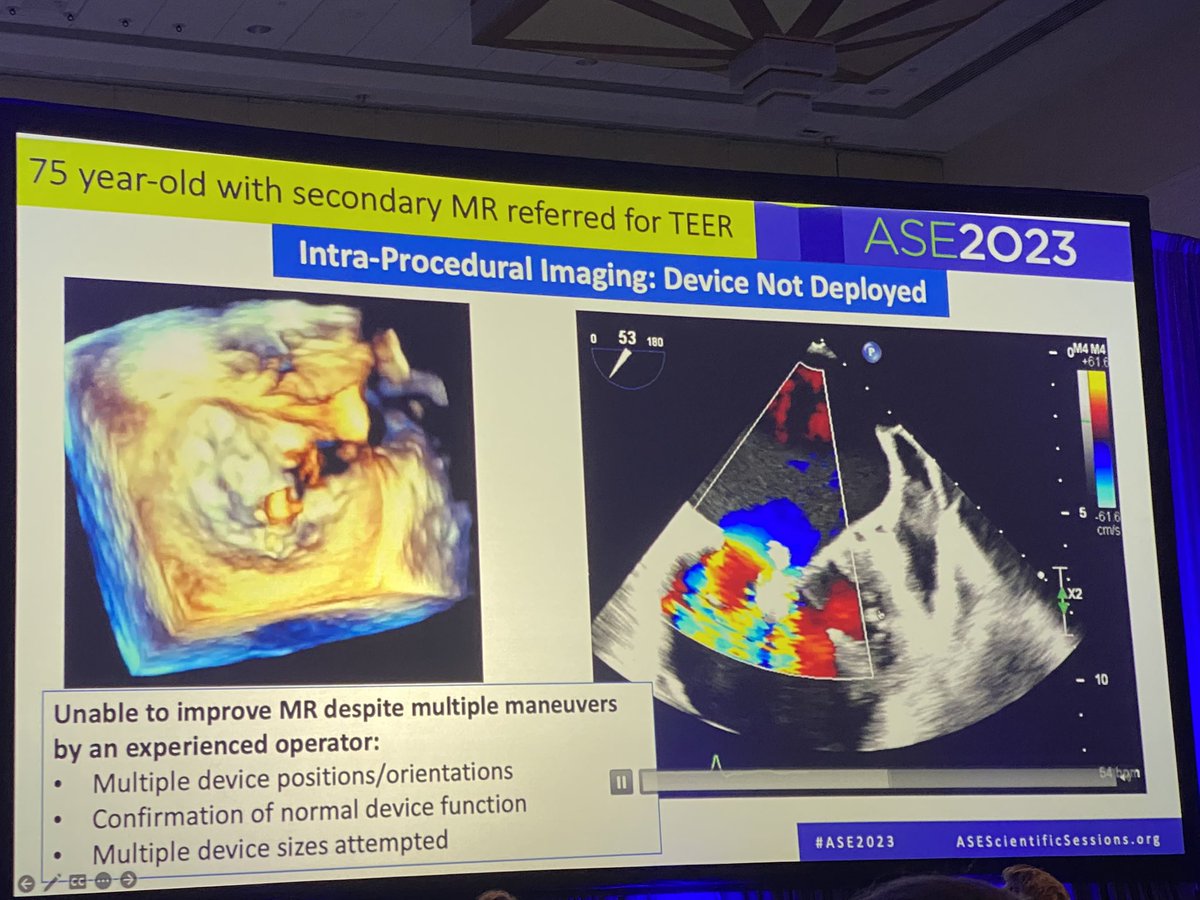 Great debates in Functional MR - TMVR versus TEER.  Residual MR versus risk of LVOTO and screen failures.  Outstanding points by <a href="/JeremyThaden/">Jeremy Thaden</a> and Frederico Asch #ASE2023 <a href="/ASE360/">American Society of Echocardiography</a>