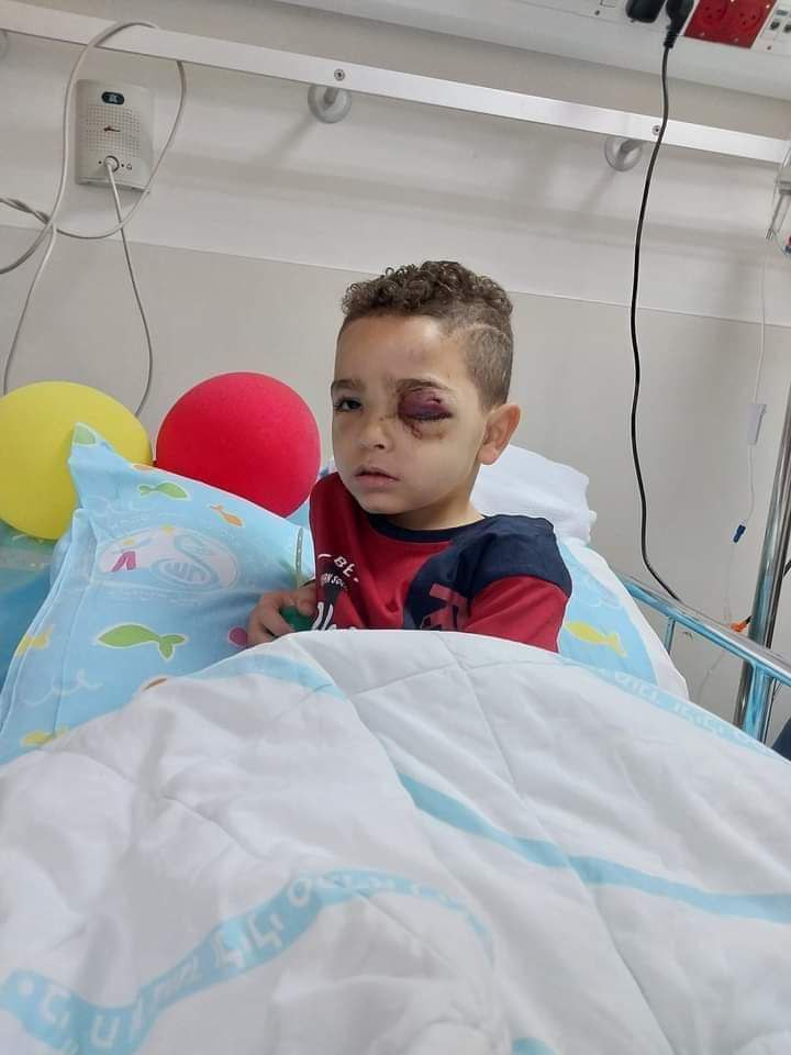 Palestinian child, Khaled Malalheh, has lost an eye after being shot by Israeli occupation forces with a rubber-coated steel bullet while inside his father's vehicle near Bazariya village, northwest of Ramallah.