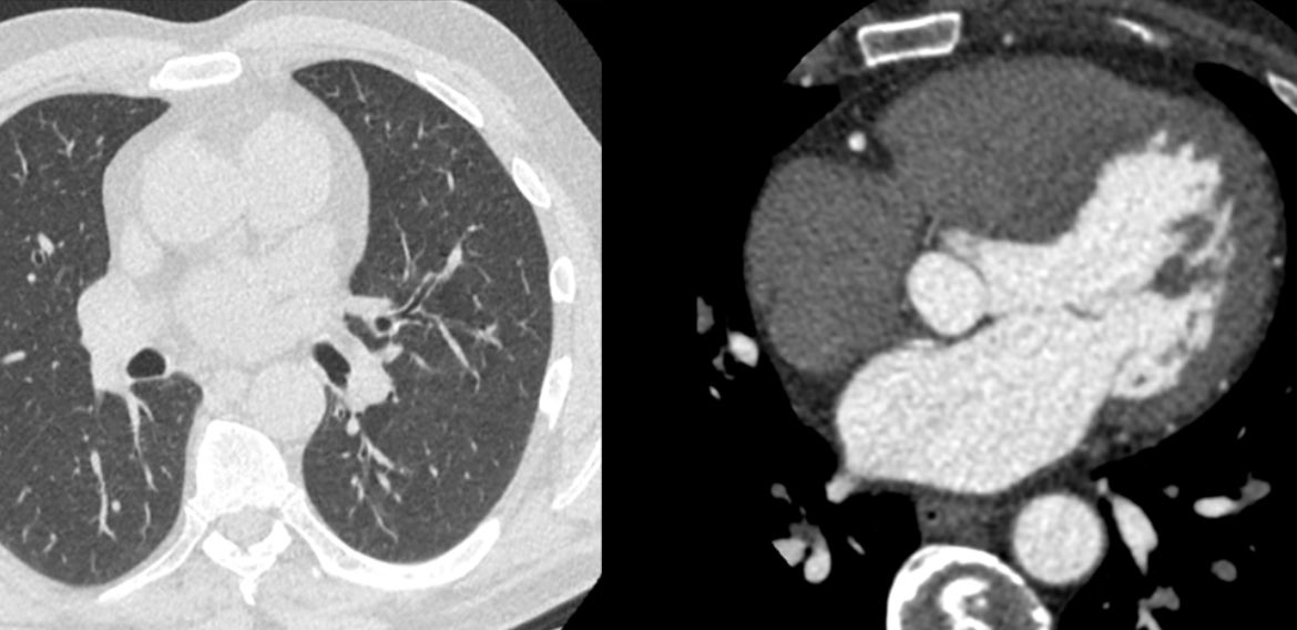 Proud of our partnerships with @InHealthGroup @AidenceVeye @cobaltimaging @Cimar_UK for helping HLH connect up the UK #chestrad community to deliver networked true subspecialty expertise & low recall rates which are so key in screening #earlydiagnosis #TLHC #ItsWhatWeDo 🩻