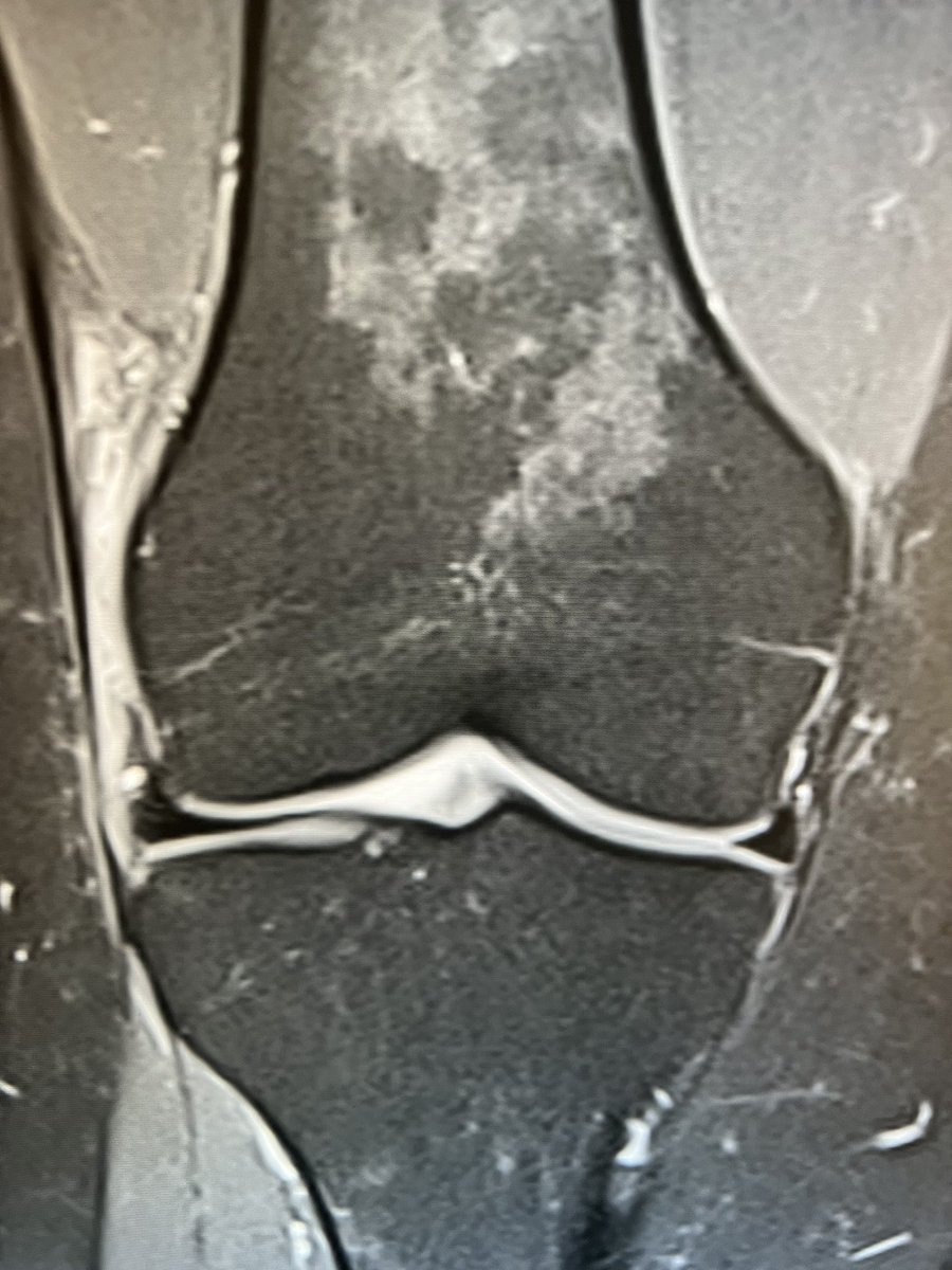 MSK Teaching Room (@mskteachingroom) on Twitter photo 35 yr F 
Knee pain
Diagnosis - ? 
#radres #mskrad #radtwitter #mskmri 35 yr F 
Knee pain
Diagnosis - ? 
#radres #mskrad #radtwitter #mskmri