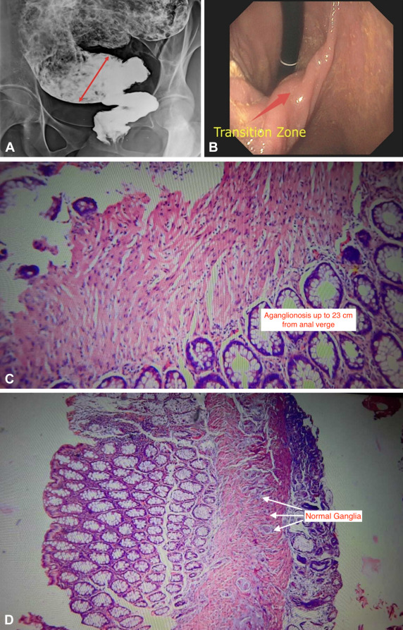 videogie's tweet image. VideoGIE Editor's Choice: “Long per-rectal endoscopic myotomy for a case of Hirchsprung’s disease” by Akshay Kulkarni et al. videogie.org/article/S2468-…
@SaurabhMukewar