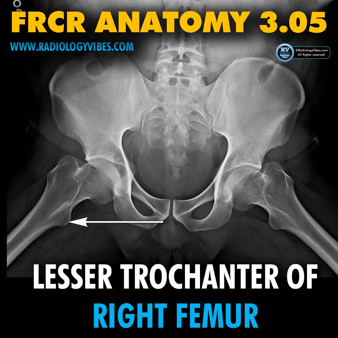 FRCR Anatomy 3.05: Lesser trochanter of right femur

#radres #FOAMrad #FRCR #radiology #anatomy #MedTwitter #radtwitter #FRCRanatomy

@Radiology_Vibes @anatomy4frcr @_the_SRT