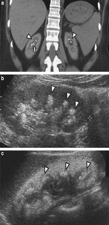 ISNkidneycare's tweet photo. 3b) Renal Calcium Oxalate (#CaOx) deposition ➡️ #nephrocalcinosis, #kidneystones, #ESKD
See 🔓https://t.co/CUq7Hf0mM9 https://t.co/czBM6RW7yV