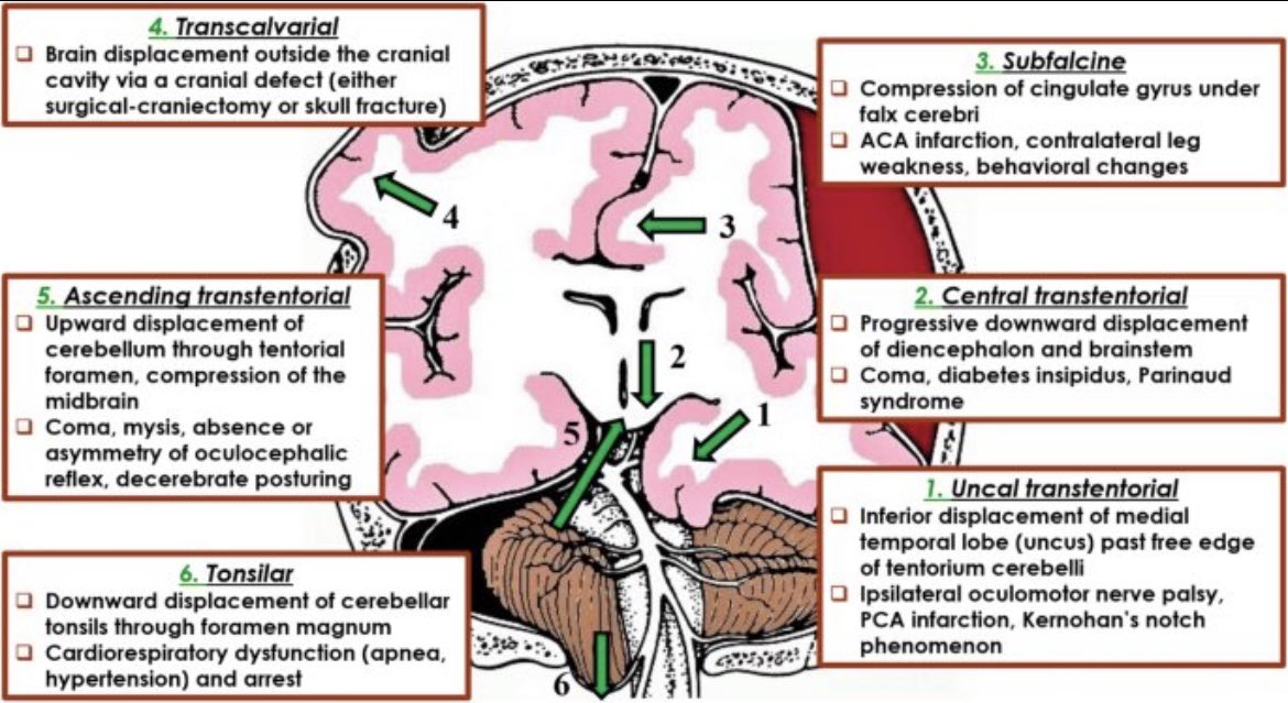 Brain Herniation Types 🧠 

#FOAMed  #MedEd #MedTwitter #Emergency #FOAped #residents #Students #medicaleducation #medicalstudent #medicalpractice 
#Neurology #neuroscience #neurotwitter #Emergency #emergencymedicine #icu #Nicu #CriticalCare