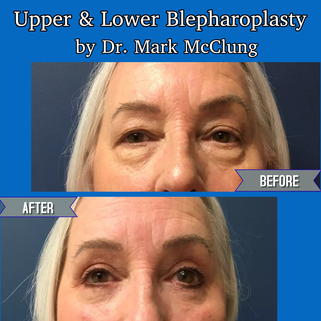 On #MakeoverMonday, behold this recent upper/lower #blepharoplasty, a procedure that improves all 4 eyelids at the same time.

This patient opted for full eyelid rejuvenation in just one surgery—because it meant only one recovery period. 

For a consultation, call (913) 451-3722.