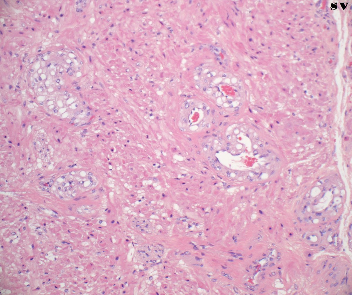 #GUpath #beautyinb9 #prostatepitfall:

compare prostate cancer from main prostatectomy specimen👀signet ring-like change
🆚
same case seminal vesicle (SV) section showing S-R like/vacuolated vessels 
(mimicker of pT3b! no #IHCPath done; main tumor well away from ejac duct/SV)