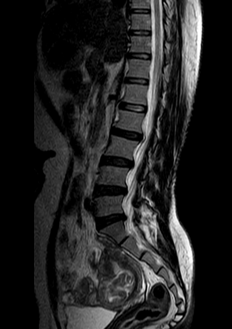 What started as a trip to the neurologist for back pain turned out to be an unexpected twist. MRI reveals a clot in the Caesarean -section  scar, uncovering a rare case of C-scar ectopic gestation.#FOAMed #FOAMrad #neuroscience #orthotwitter #neurosurgeon #MedTwitter