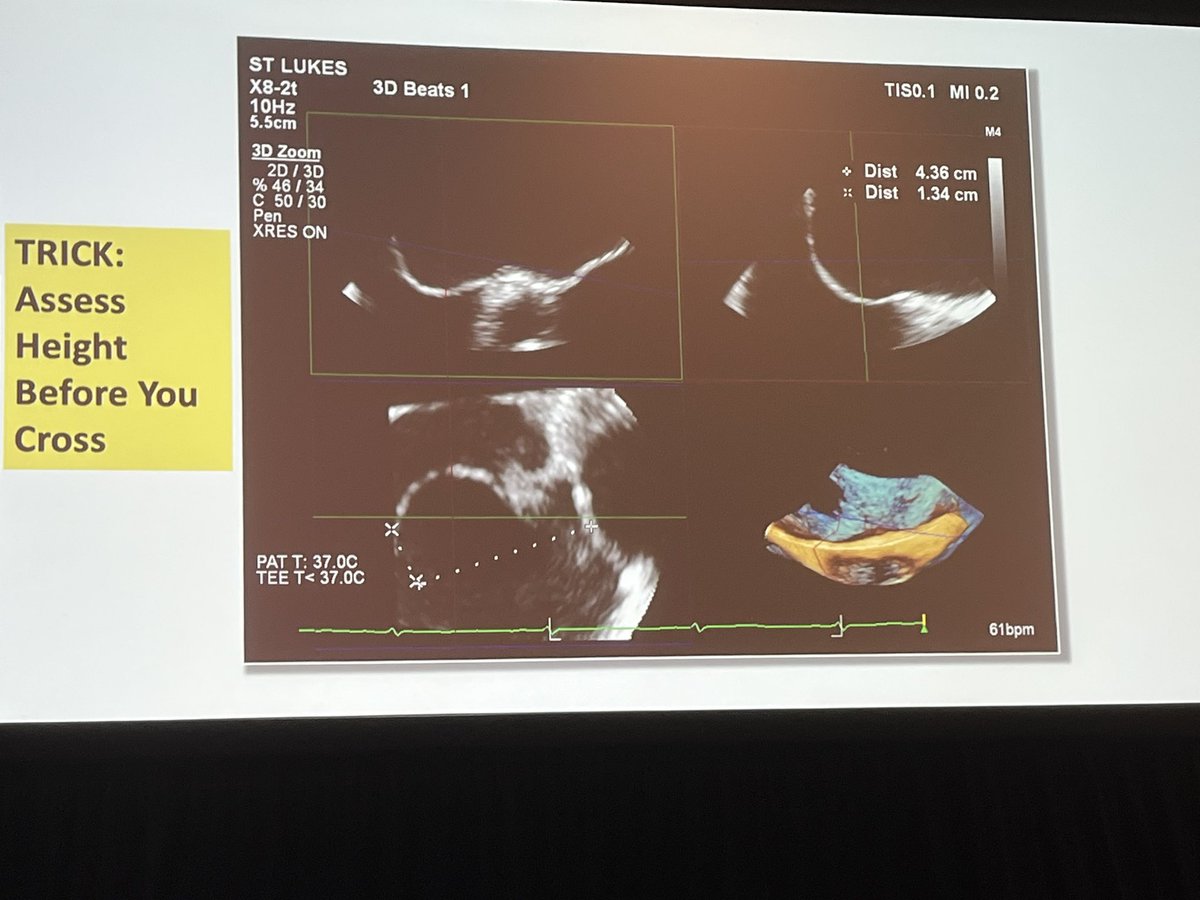 EGarciaSayan's tweet photo. Tips and tricks for trans septal puncture guidance by @renujain19 at #ASE2023. Know the anatomy and where you want to go, targeted TSP for specific device &amp; anatomy. Know basic 2D views &amp; 3D MPR. Know the technology. Know when to modify / adaptability. Know what can go wrong! https://t.co/cob0aGUPhk