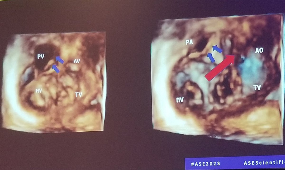 Sensing a theme? Anitha Parthiban walking us through how 3d echo helps understand whether remote VSDs are amenable to 2V repair. Not just pretty pictures. #ASE2023 @ASE360