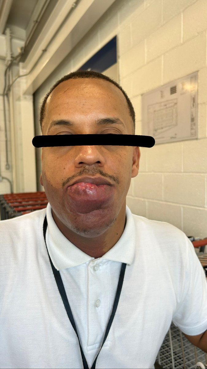 jusanz11's tweet image. 🚨RT por DOMINGO. 🚨
El día de hoy conocí a Domingo, un joven muy trabajador que tiene una deformidad de nacimiento en su labios, me puse a hablar con él y le pregunté si le gustaría que lo ayuden a operarse, a lo que él con una sonrisa de esperanza dibujada en el rostro,…