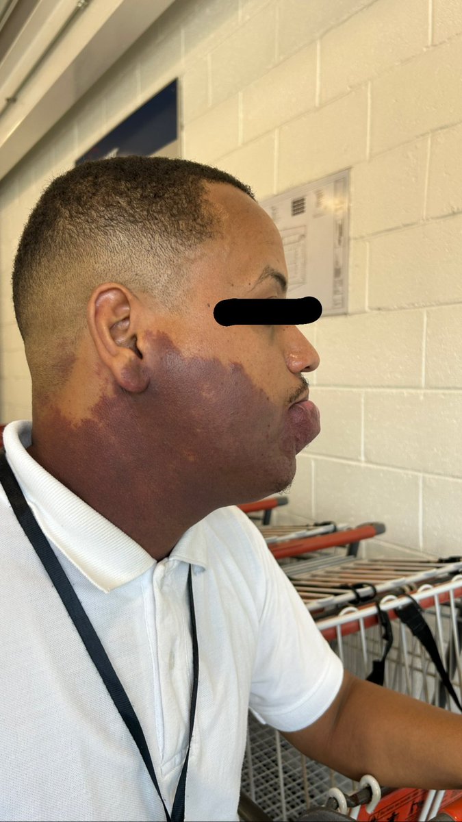 jusanz11's tweet image. 🚨RT por DOMINGO. 🚨
El día de hoy conocí a Domingo, un joven muy trabajador que tiene una deformidad de nacimiento en su labios, me puse a hablar con él y le pregunté si le gustaría que lo ayuden a operarse, a lo que él con una sonrisa de esperanza dibujada en el rostro,…