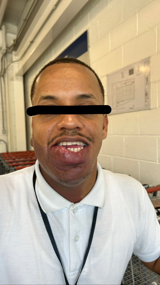 jusanz11's tweet image. 🚨RT por DOMINGO. 🚨
El día de hoy conocí a Domingo, un joven muy trabajador que tiene una deformidad de nacimiento en su labios, me puse a hablar con él y le pregunté si le gustaría que lo ayuden a operarse, a lo que él con una sonrisa de esperanza dibujada en el rostro,…