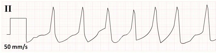 How to Diagnose Atrial Fibrillation - Top 5 Tips
acadoodle.com/articles/12
#emergencymedicine #intensivecare #respiratory #respiratorycare #icu #nurses #icunurse #ecg #ekg #cme #cmeonline