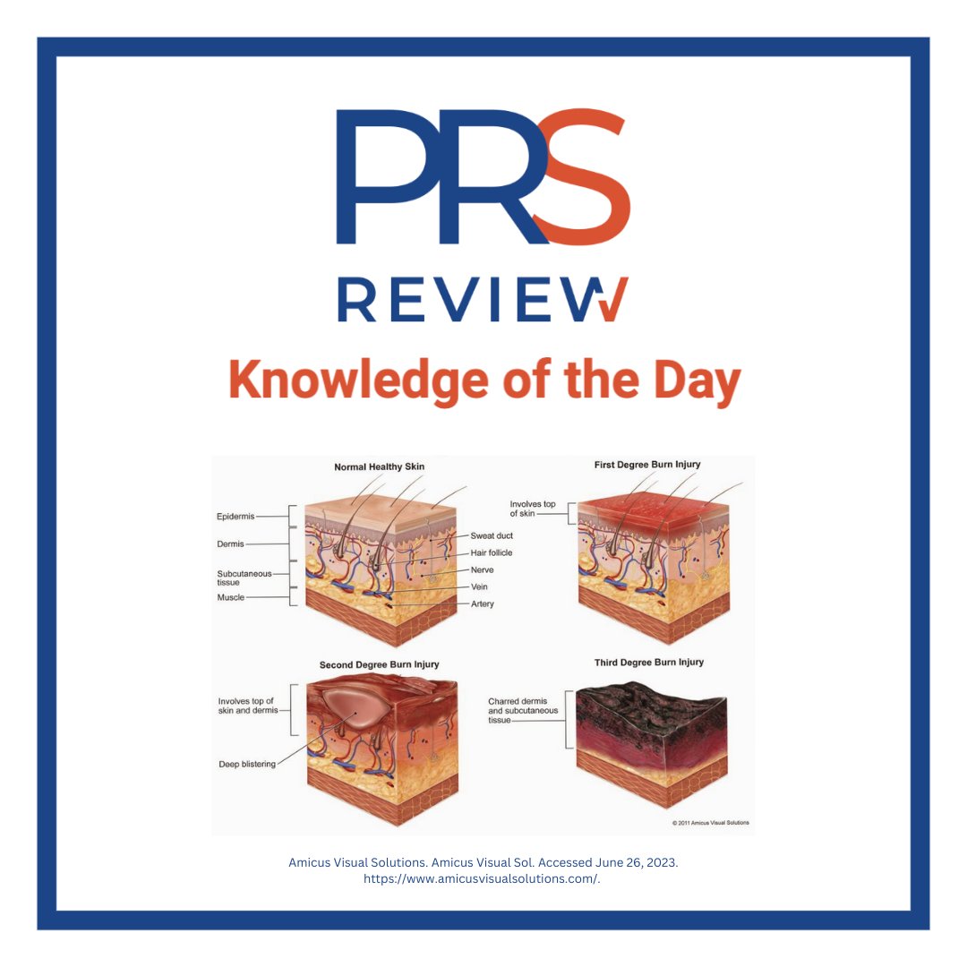 Stages of burn injuries

#prsreview #burn #burninjury #burnstaging #firstdegreeburn #seconddegreeburn #thirddegreeburn #burnsurgery #plasticsurgery #reconstructivesurgery #surgicaleducation #medicaleducation #meded #plasticsurgeryresidency  #plasticsurgeon #surgery