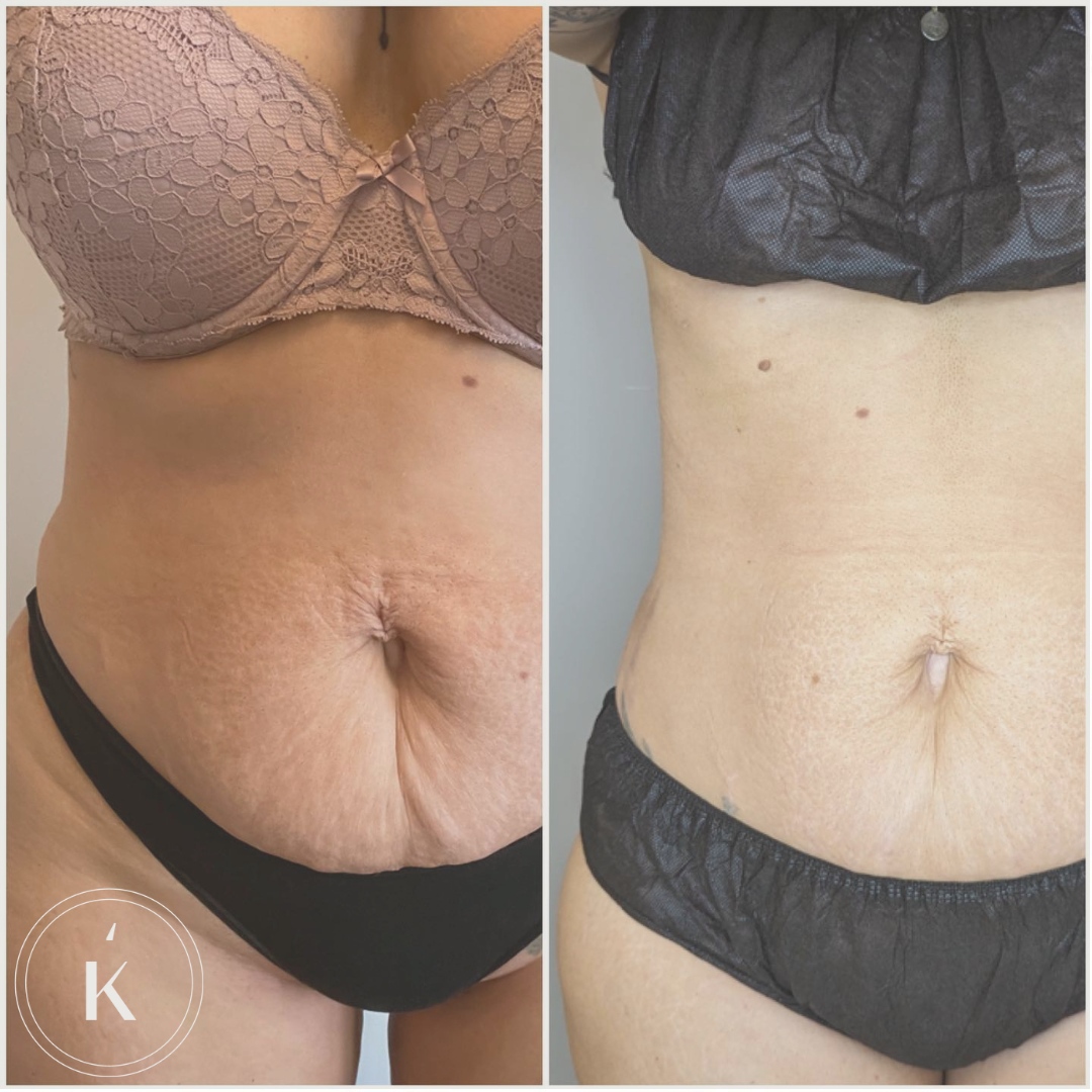 Tired of stubborn fat that won't go away? 

Try out fat freezing to get the body you've always wanted! Book a consultation now!

#FatFreezing #medspa #tummytuck #bodycontouring #bodysculpting #nodowntime #noninvasive #noninvasivebeauty