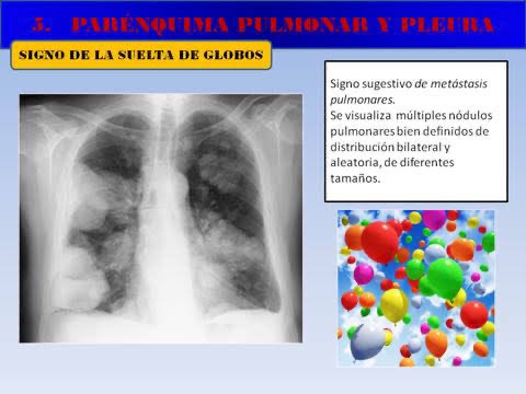 @GesconsEduca Metástasis pulmonar 👇