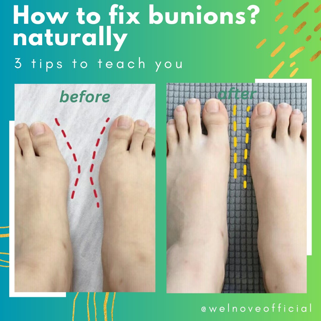 Welnove's tweet photo. 👣How to fix a bunion naturally? (without surgery) You can refer to the content of the picture to practice, encounter foot problems, let welnove to help you.😀
#Welnove #toespacers #healthyfeet #toesprotectors #corn #blister #overlappingtoe https://t.co/mPumXeBLl5